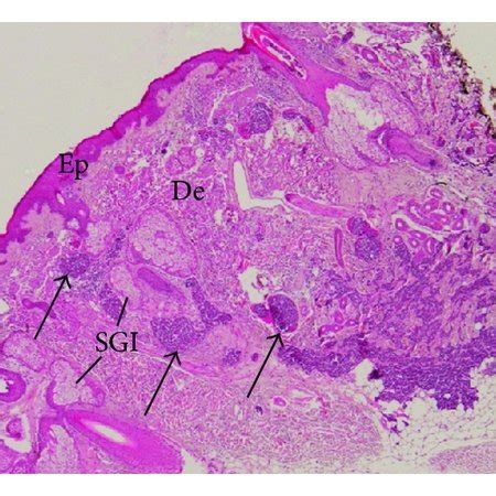 Representative Example Of Histology Of Merkel Cell Carcinoma From A