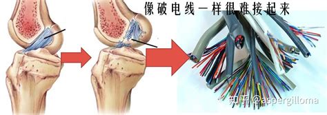 前交叉韧带撕裂了该怎么办 知乎