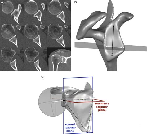 Measurement Of The Glenoid A The Subchondral Bone Of The Glenoid