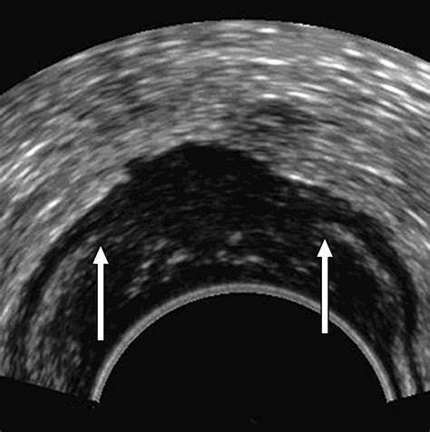 Perspective On The Role Of Transrectal And Transvaginal Sonography Of