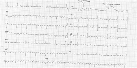 Ekg Z Praxe Medic Na Nemoci Studium Na Lf Uk