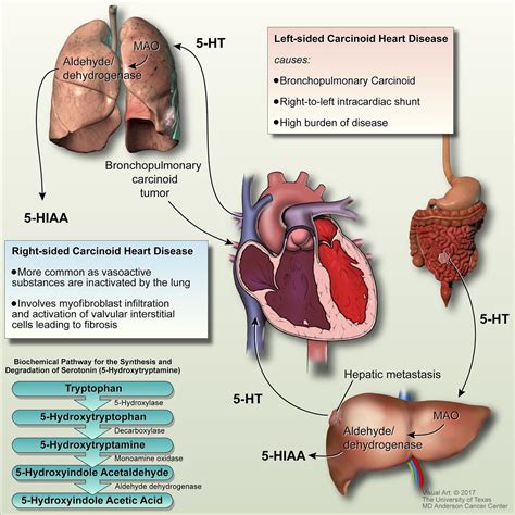 Carcinoid Heart Disease Heart