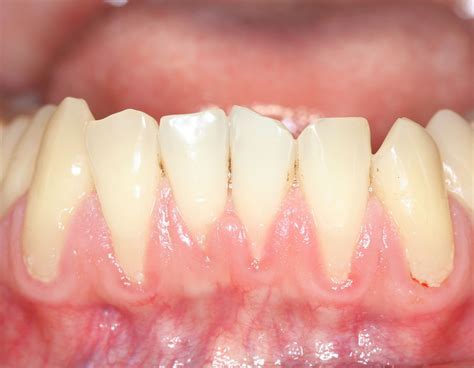 Cirugía Periodontal Injerto Encía Alargamiento Coronario Clínica