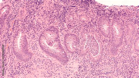 Photomicrograph Of A Colon Biopsy Obtained During Colonoscopy Showing