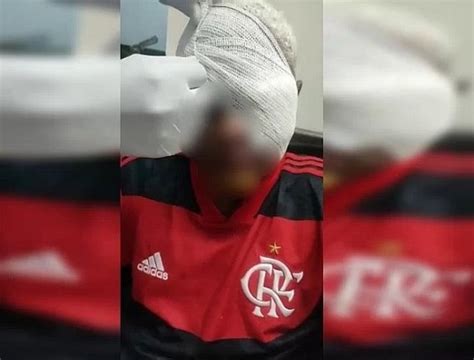 Jovem autista perde olho após ser espancado em jogo de futebol Portal