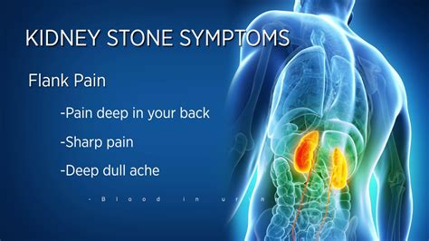 Kidney Stones Ultrasound