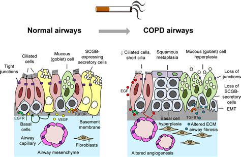 Figure 1 From Early Events In The Pathogenesis Of Chronic Obstructive