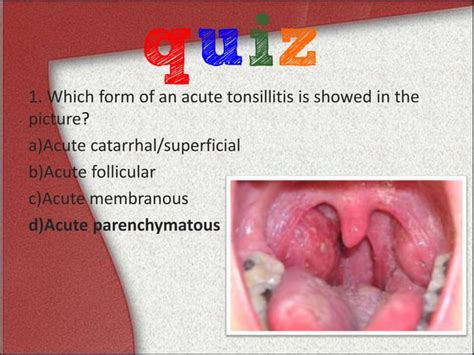 Acute Tonsillitis Ppt