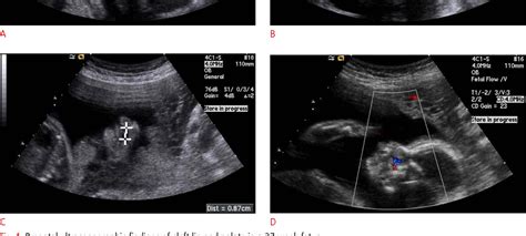 Figure From Value Of Sagittal Color Doppler Ultrasonography As A