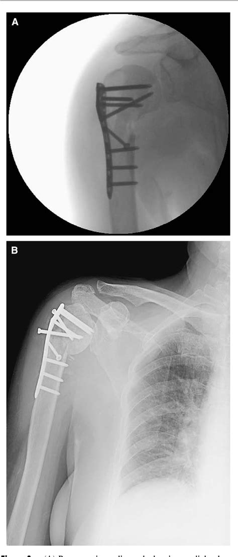 Figure From Prognostic Factors For Unstable Proximal Humeral