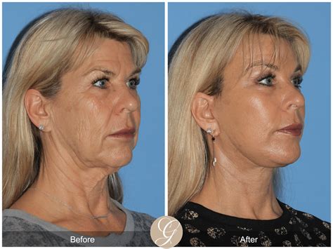deep plane facelift case     orange county