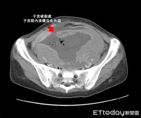 曾懷死胎！台中女「少做一事」肌瘤長到17公分大 竟撐破子宮 Ettoday生活新聞 Ettoday新聞雲