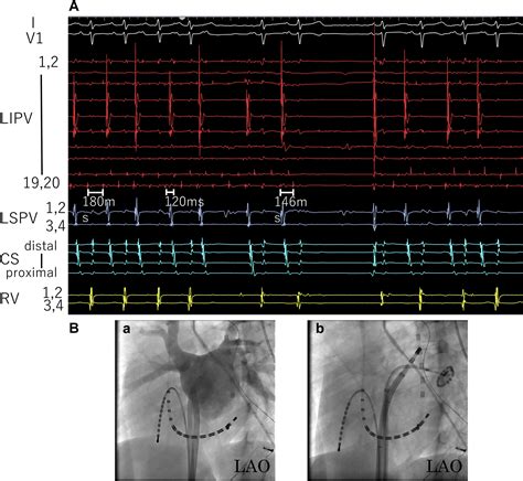 A Case Of Pediatric Atrial Fibrillation Ablation Resulting In Unilateral Pulmonary Vein