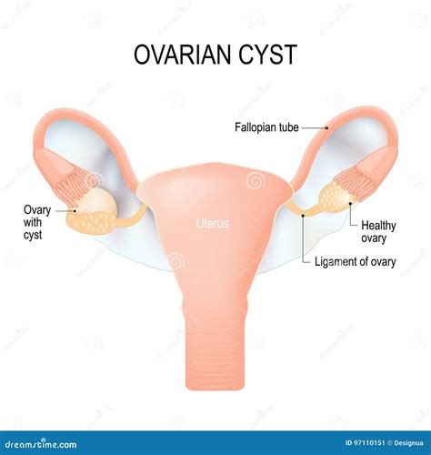 Saco Lleno De Fluido Ov Rico Del Quiste A En El Ovario Ilustraci N Del
