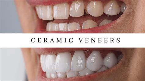 Unveiling The Smile Makeover Ceramic Vs Composite Bonding Veneers