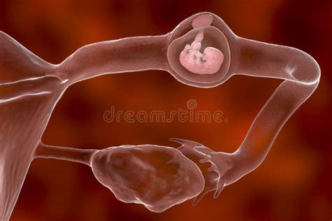 Tubal Ectopic Pregnancy D Illustration Stock Illustration