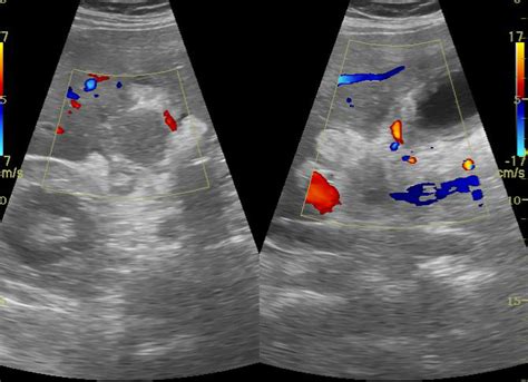 Gallbladder Perforation Image