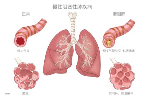 慢性阻塞性肺疾病（标注版） 医学插画