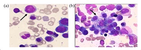 The Morphology Of Bone Marrow Cells The Pathological Result Showed