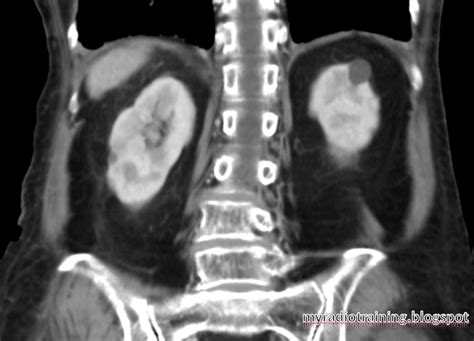 Radiology info hub: Bosniak classification for Renal Cyst