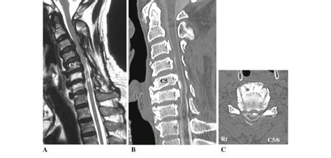 Case 7 T2 Weighted Midsagittal MR Image A And A CT Midsagittal