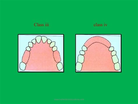 Rpd Classification Final Dental Implant Courses By Indian Dental A