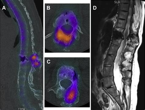 Andersson Lesion In Ankylosing Spondylitis The Spine Journal