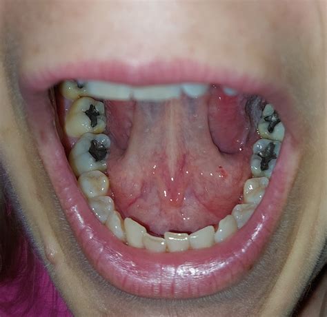 Zunge Von Unten Denta Beaute