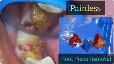 Painless Tooth Extraction Root Pieces Removal Youtube