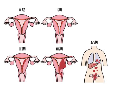 子宮体がん（子宮体癌）｜原因・症状・対策・治療｜大正健康ナビ｜大正製薬