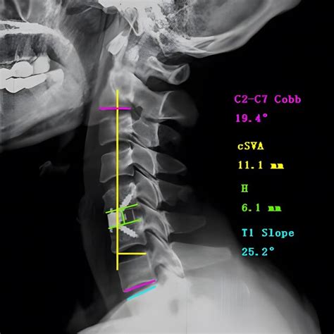 Parameters Defining Cervical Sagittal Alignment And Analysis Example Download Scientific