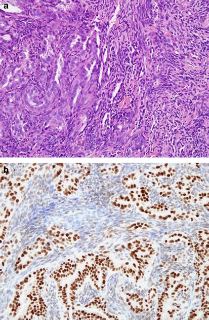 Biphasic Synovial Sarcoma A With 3 TLE1 Expression In Glandular