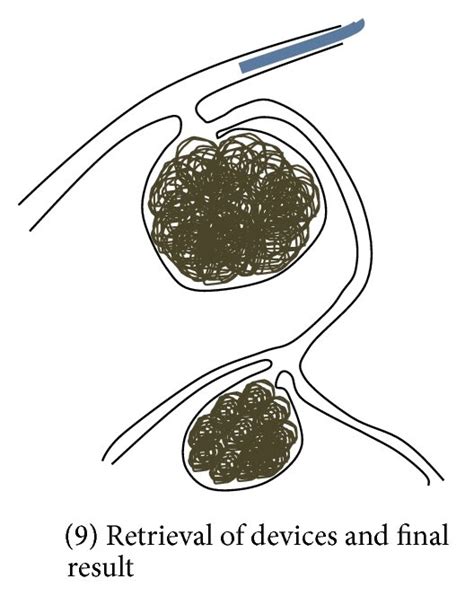 Diagram demonstrating the steps of the procedure. SMA: superior... | Download Scientific Diagram