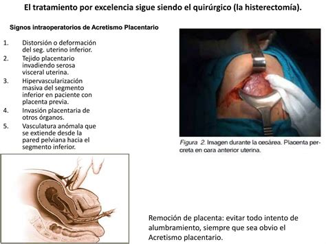 Acretismo Placentario Ppt