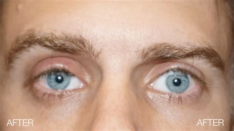 Ptosis Repair Eyecare Virginia Beach