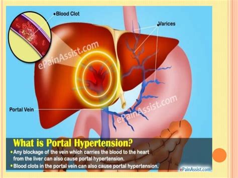 Portal Hypertension Liver Cirrhosis And Liver Transplant