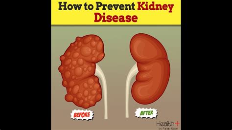 How To Prevent Kidney Disease Youtube