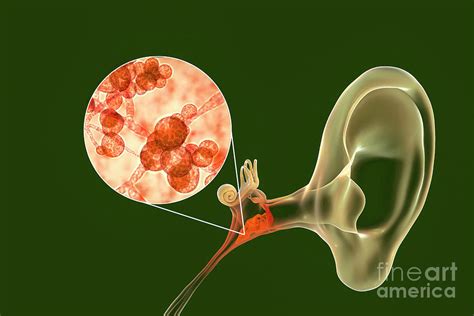 Chronic Fungal Otitis Media Ear Infection Photograph By Kateryna Kon