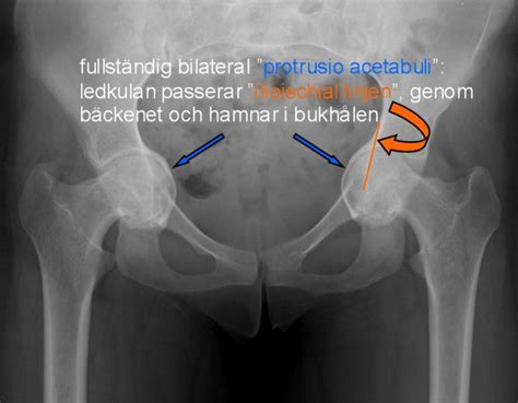 Protrusio Acetabuli