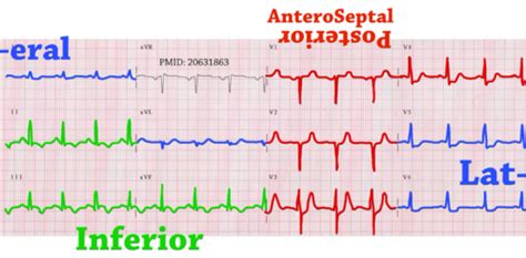 Chest Pain And Acute Coronary Syndrome Flashcards Quizlet