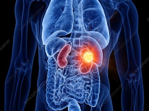 Kidney Cancer Illustration Stock Image F0276060 Science Photo