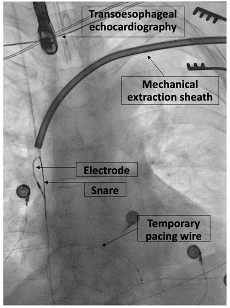 Jcm Free Full Text Success And Complication Rates Of Transvenous