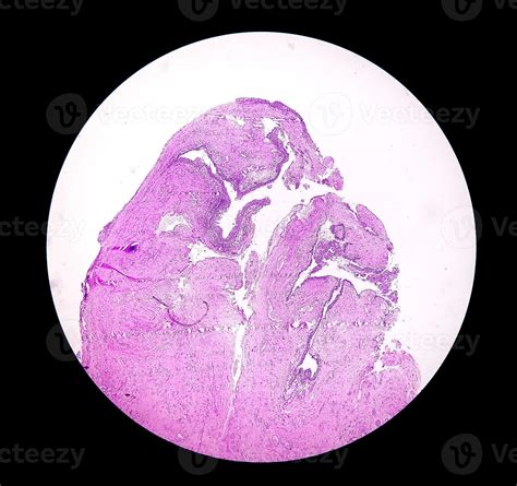 Histology Of Urachal Cyst Photomicrograph Of Histological Stained