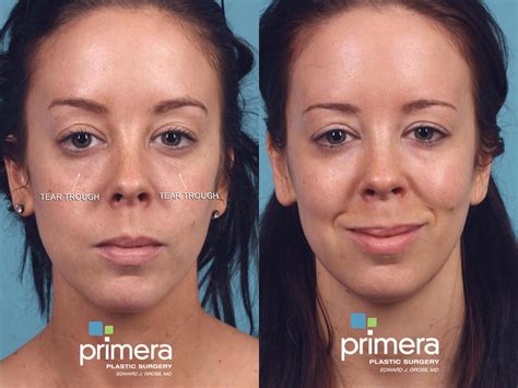 Restylane® for Orlando & Winter Park, FL | Primera Plastic Surgery