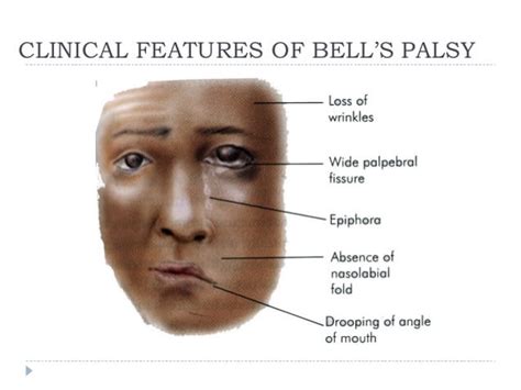 Bells Palsy Diagram