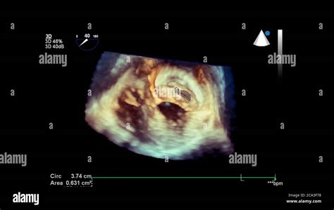 3d Ultrasound Of The Heart