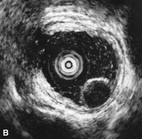 Endoscopic Resection Of The Esophageal Squamous Cell Carcinoma