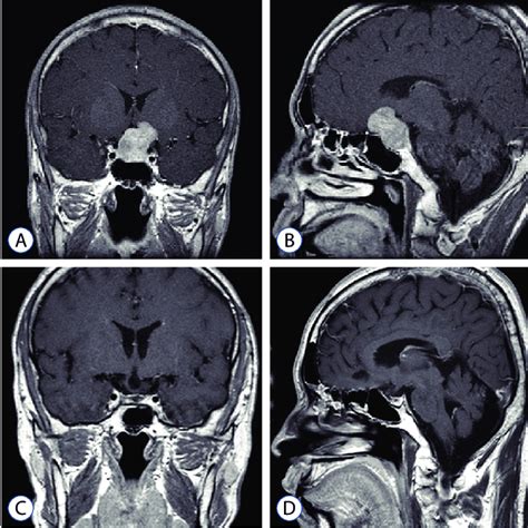 Representative Case Of TSH Secreting Pituitary Adenomas In A