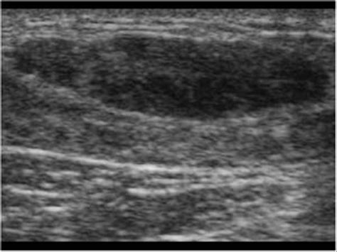 Breast and Axilla | 5.1 Benign lesions : Case 5.1.6 Fibro adenomas ...