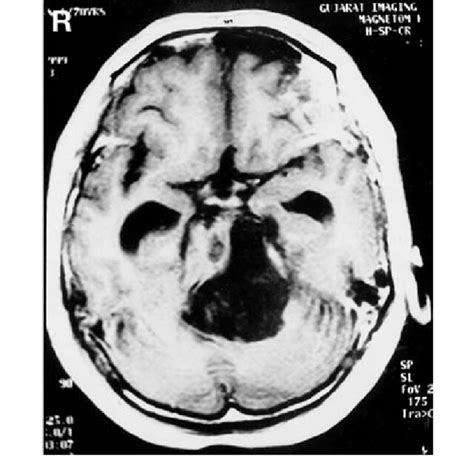 Preoperative Axial T 1 Weighted Magnetic Resonance Image Showing The